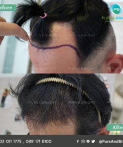 FUE before after 5mo 2