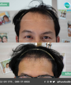 FUE before after 5mo 3