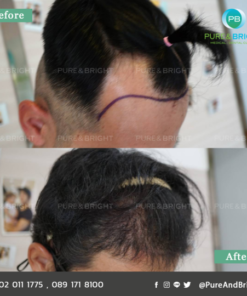 FUE before after 5mo 4