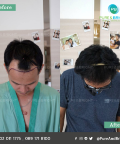 FUE before after 5mo 6