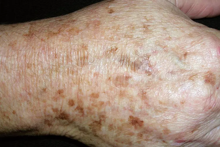 กระ (Freckles หรือ Ephelides) ลักษณะเป็นจุดสีน้ำตาลขนาดเล็ก มักเห็นชัดขึ้นเมื่อได้รับแสงแดด