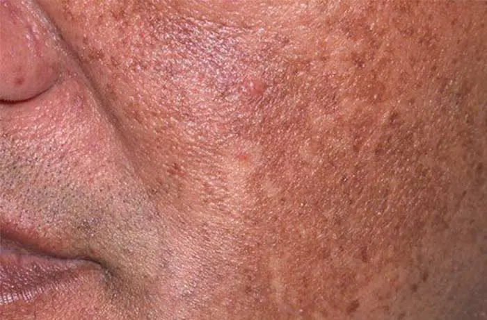ฝ้า (Melasma) ลักษณะเป็นปื้นสีน้ำตาลถึงเทาบนใบหน้า มักพบบริเวณแก้ม หน้าผาก และเหนือริมฝีปาก