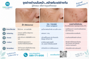 ฝ้า กระ กระแดด และรอยดำหลังอักเสบต่างกันอย่างไร เปรียบเทียบลักษณะ สาเหตุ ตำแหน่ง และแนวทางการรักษา