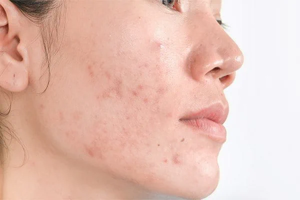 รอยดำหลังอักเสบ (PIH) เป็นรอยสีน้ำตาลหรือเทาบริเวณที่เคยมีการอักเสบ เช่น รอยหลังสิว